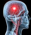 Concussion TBI